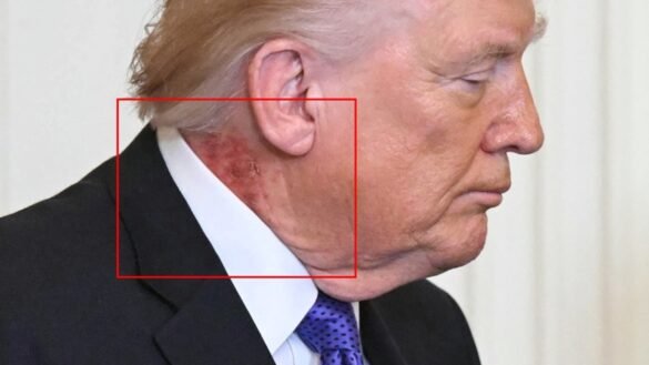 Rash on Donald Trump's Neck Raises Health Questions