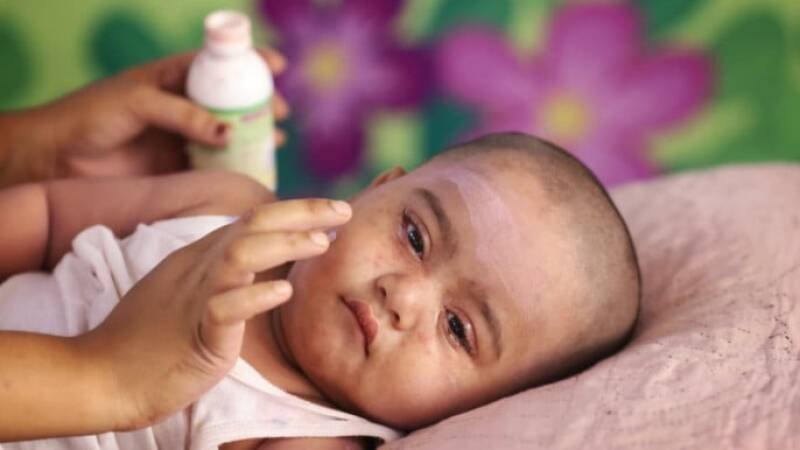 Measles Outbreak Claims Lives: Understanding the Risks and Future Outlook